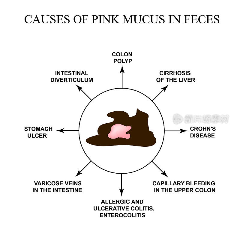 Causes of pink mucus in feces. Diseases of the gastrointestinal tract. Infographics. Vector illustration on isolated background.